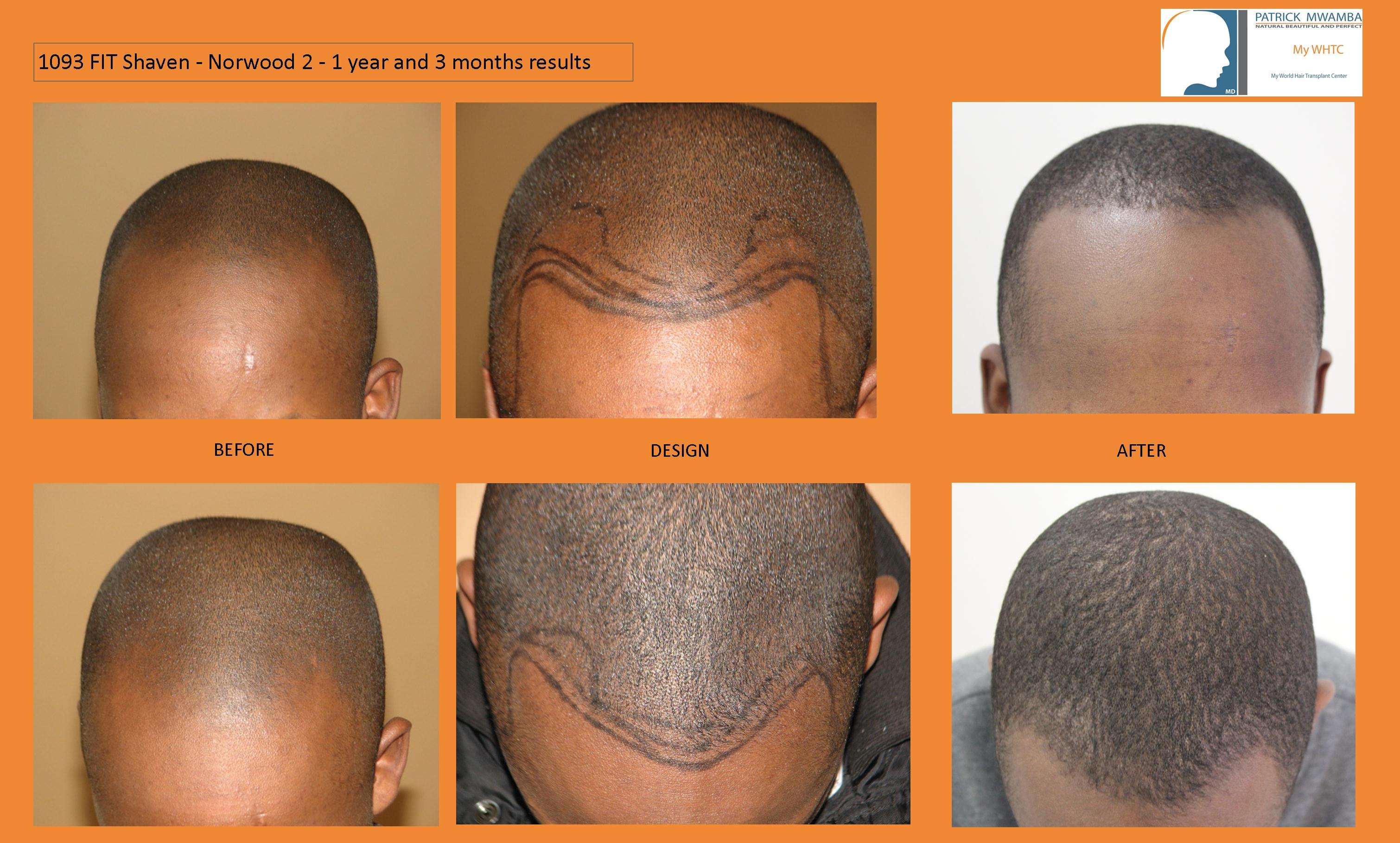 Dr Mwamba - Fit shaven in black patient is quite a challenge. | Hair loss  Forum - Hair Transplant forums